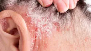 best cream for scalp psoriasis, eczema, itching, redness