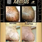 before and after psoriasis treatment skin condition