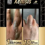 before and after psoriasis treatment skin condition