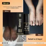 before and after psoriasis treatment skin condition