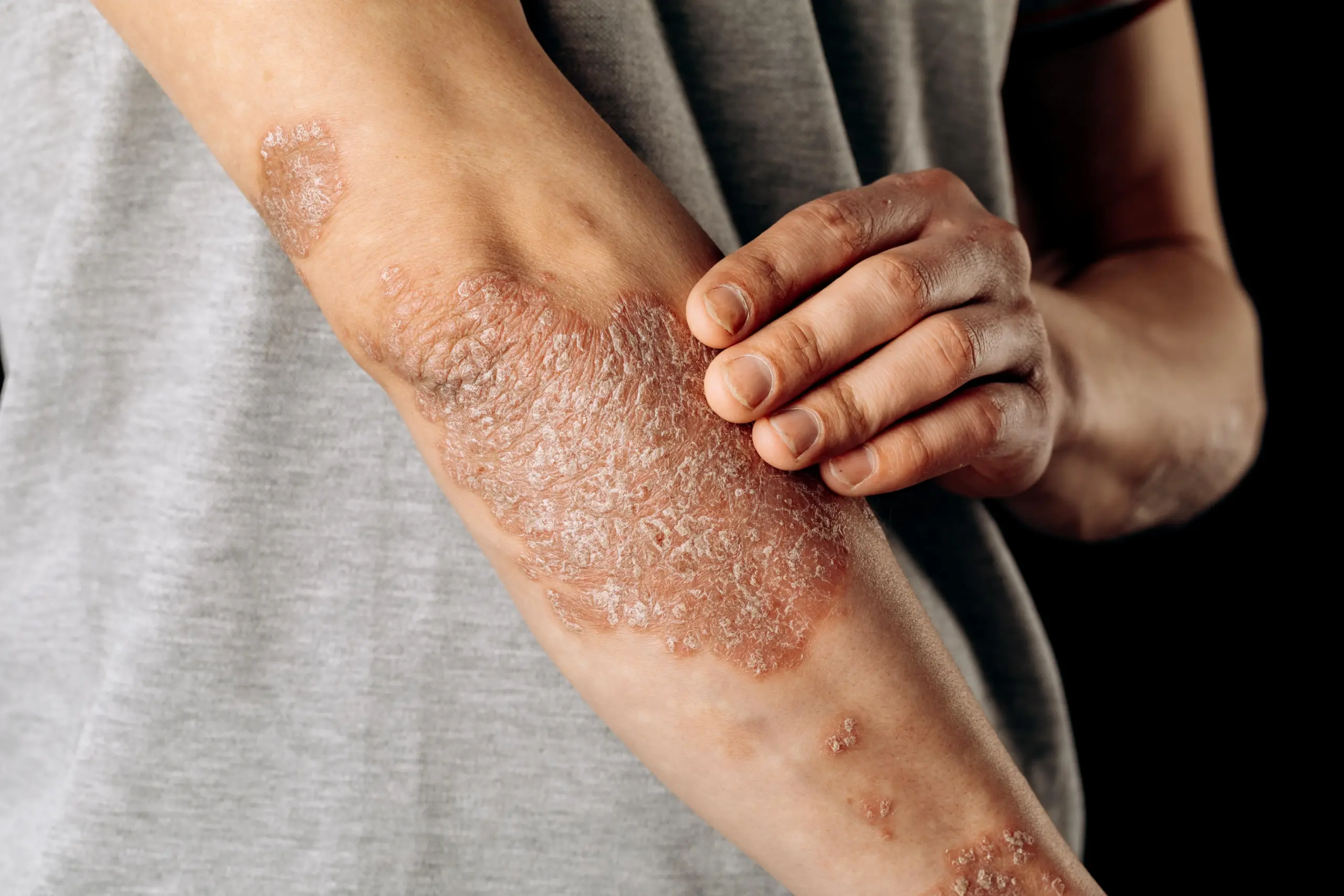 acute-psoriasis-elbows-is-autoimmune-incurable-dermatological-skin-disease-large-red-inflamed-flaky-rash-elbows-joints-affected-by-psoriatic-arthritis-min