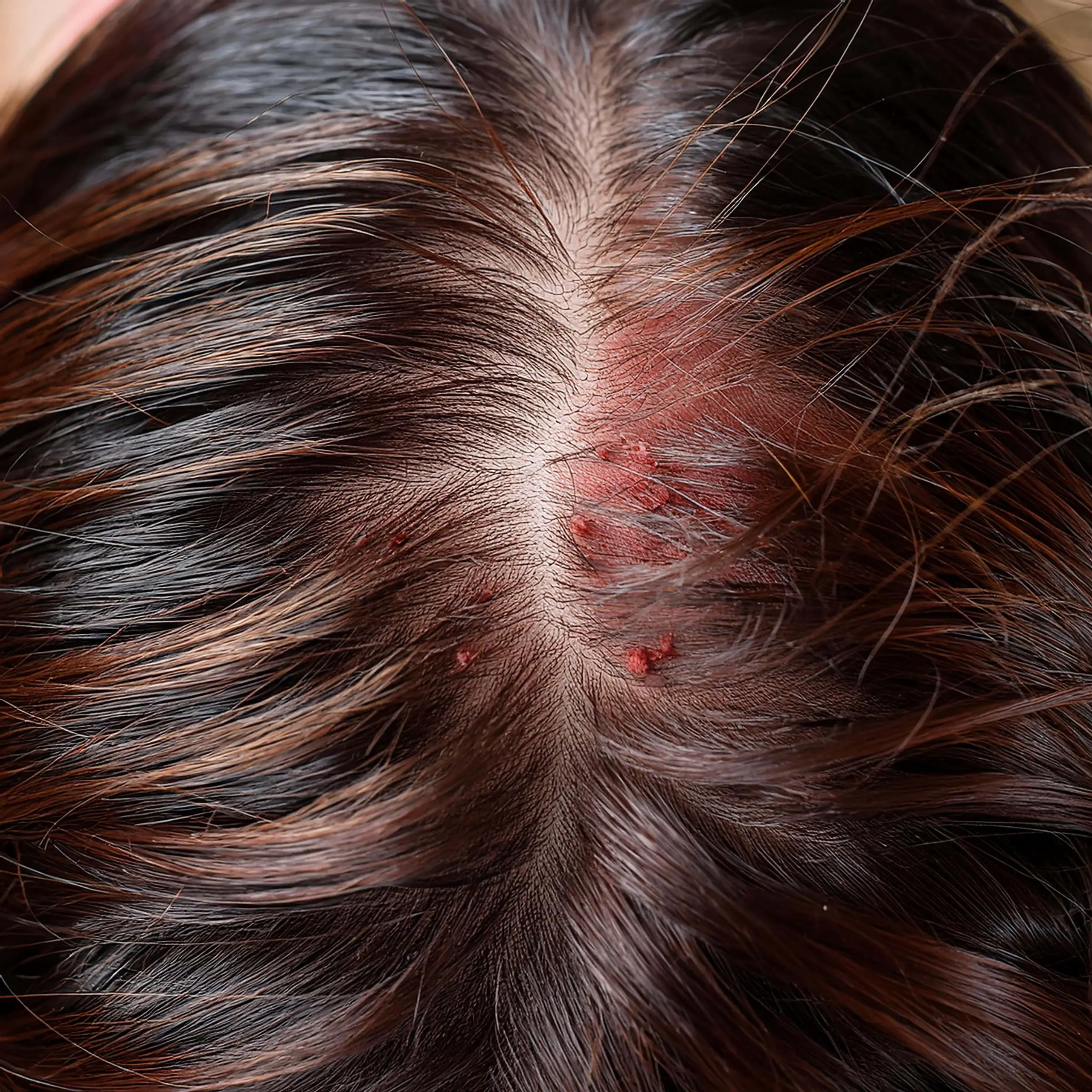 closeup-psoriasisaffected-scalp-with-thick-silvery-scales-red-patches-min (1)