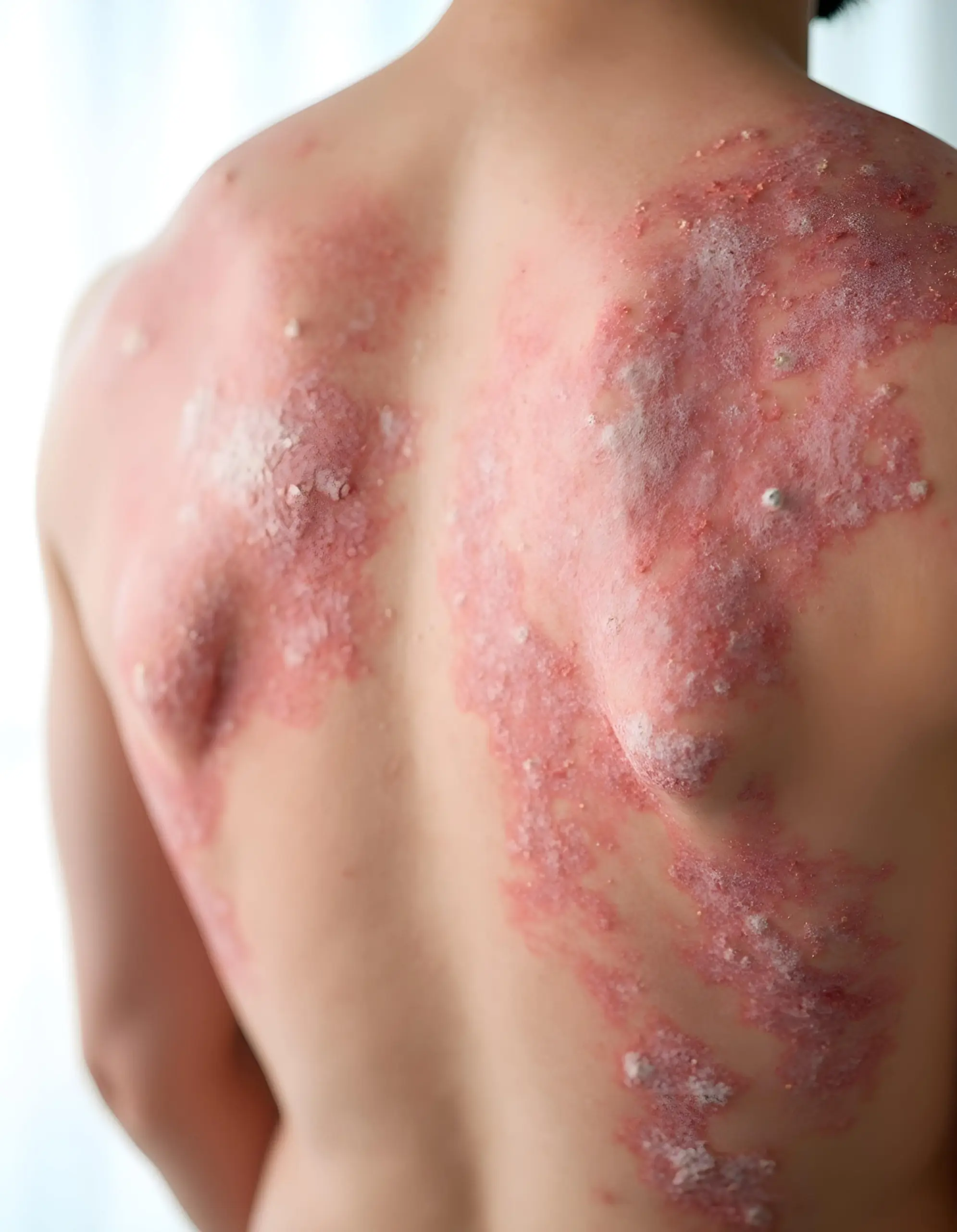 skin-condition-medical-problem-psoriasis-white-background-min