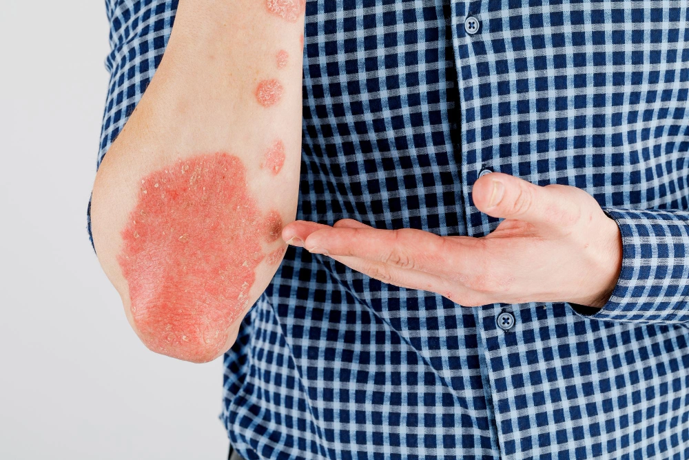 Erythrodermic Psoriasis
