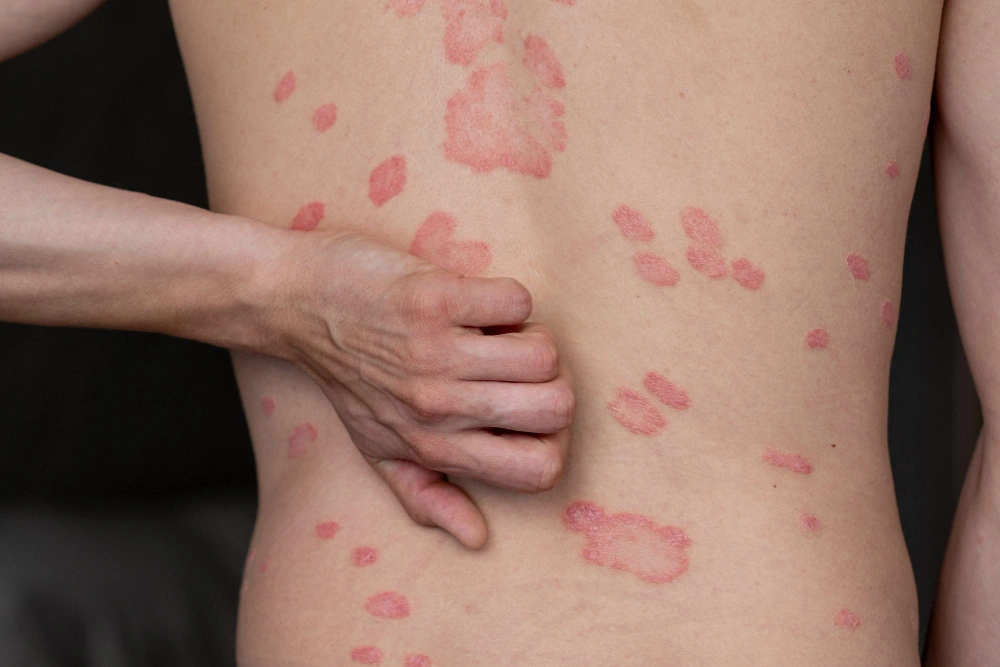 Guttate Psoriasis